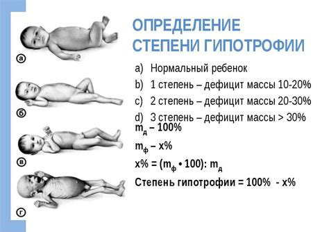 Основные симптомы гипотрофии 1 степени у детей