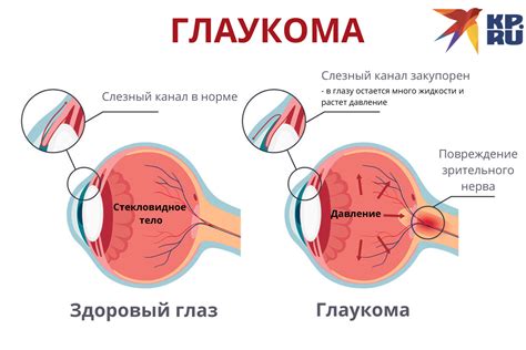 Основные симптомы глаукомы