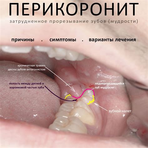 Основные симптомы гниения зуба мудрости