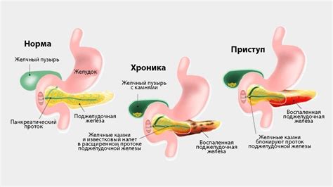 Основные симптомы жиранома