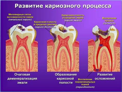 Основные симптомы кариеса корня зуба