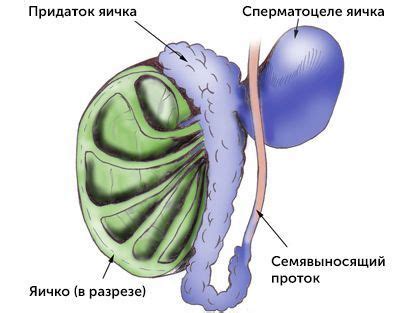 Основные симптомы кисты левого придатка у мужчин