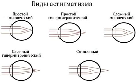 Основные симптомы миопатического астигматизма обоих глаз