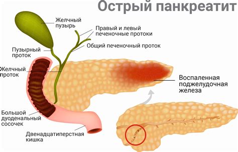 Основные симптомы острого неуточненного панкреатита