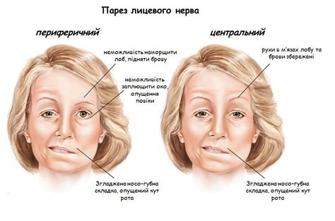 Основные симптомы пареза конечности