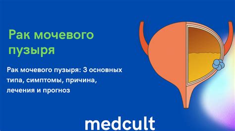 Основные симптомы плоскоклеточной метаплазии мочевого пузыря