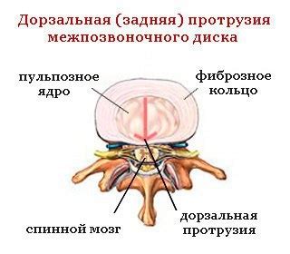 Основные симптомы протрузии