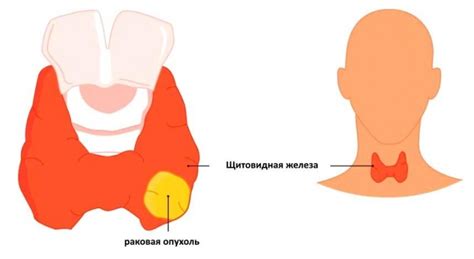 Основные симптомы рака щитовидки