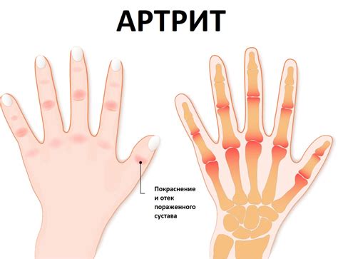 Основные симптомы реактивного артрита у детей