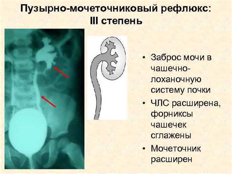 Основные симптомы рефлюкса мочи