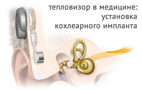 Основные характеристики кохлеарного импланта