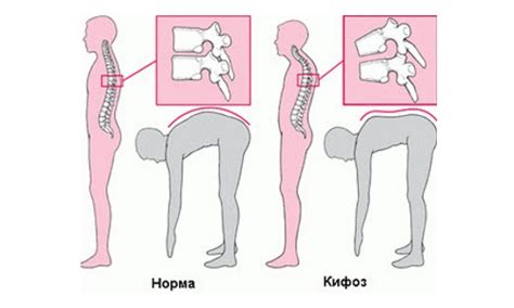 Основные характеристики усиленного кифоза