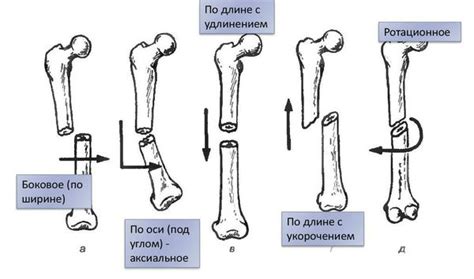 Особенности наложения шины на различные типы переломов