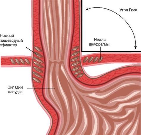 Особенности недостаточности нижнего пищеводного сфинктера