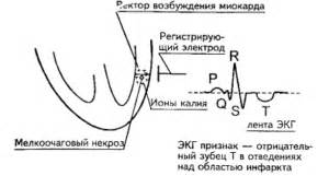 Особенности нормостеников при ЭКГ