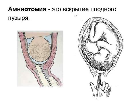 Особенности плоского плодного пузыря