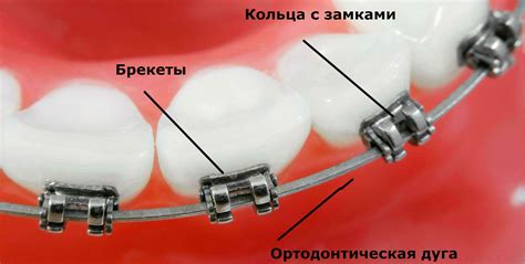 Особенности ухода за самолигирующимися брекетами