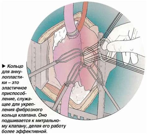 Особенности функционирования митрального клапана противофаза