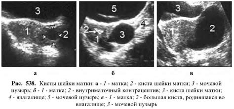 Особенности эндоцервикса 1мм