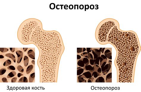 Остеопороз видимых костей