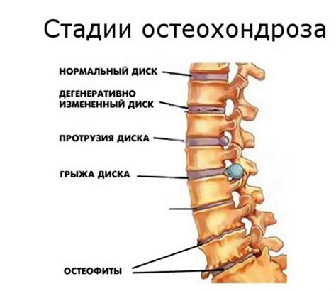 Остеохондроз и протрузии