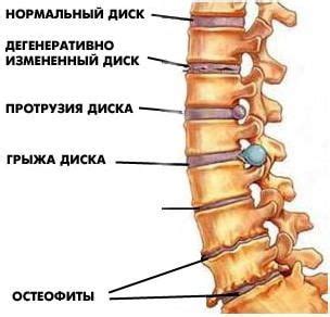 Остеохондроз поп – что это значит?