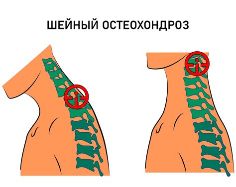 Остеохондроз шейного отдела: причины нехватки воздуха и способы облегчения