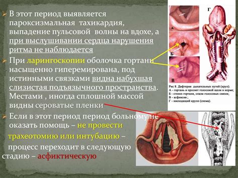 Острая инфекционная болезнь