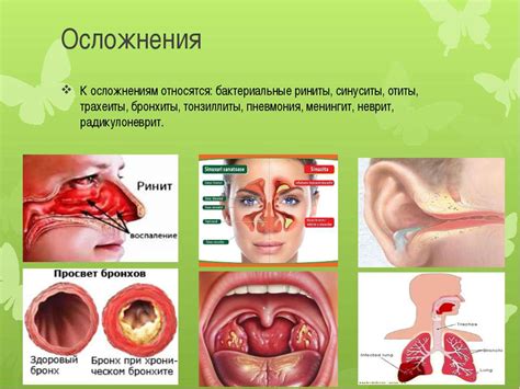 Острая респираторная инфекция