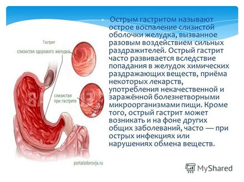 Острое воспаление слизистой желудка