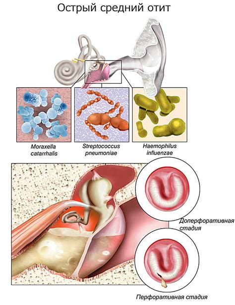 Острое воспаление среднего уха