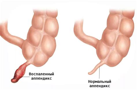 Острый аппендицит: причины и симптомы