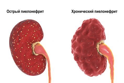 Острый пиелонефрит