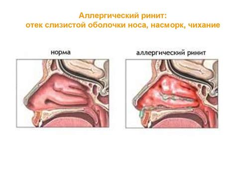 Отек носовой полости: причины, симптомы, лечение