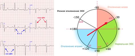 Отклонение оси ЭКГ вправо: важная информация для диагностики