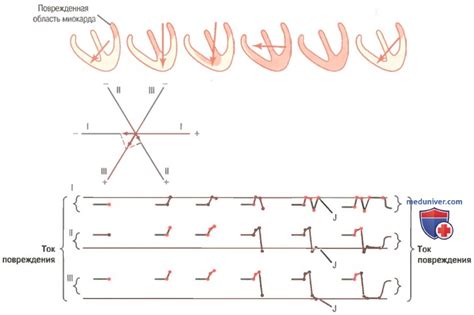 Отклонение параметров QRS 111: