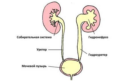 Открытая лоханка почки у взрослого