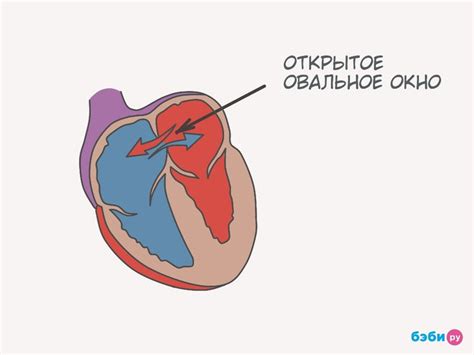 Открытие овального окна в сердце ребенка