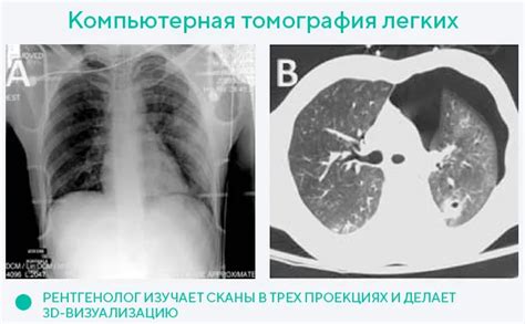 Отличия рентген легких обзорного от компьютерной томографии