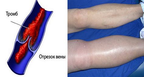 Оторванный тромб: определение и симптомы