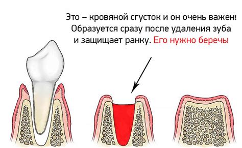 Отражение боли: интерпретация процесса извлечения зуба без проникновения крови