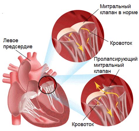 Отрыв хорды митрального клапана