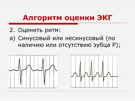 Оценка ритма синусового нерегулярного с ЧСС