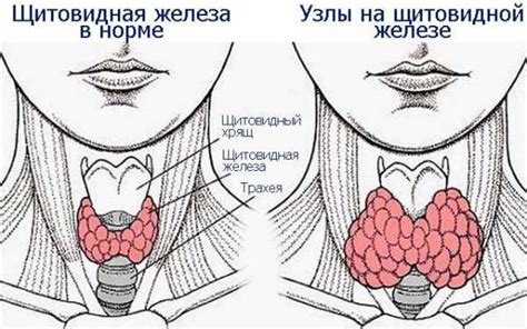 Очаговое изменение левой доли щитовидной железы: