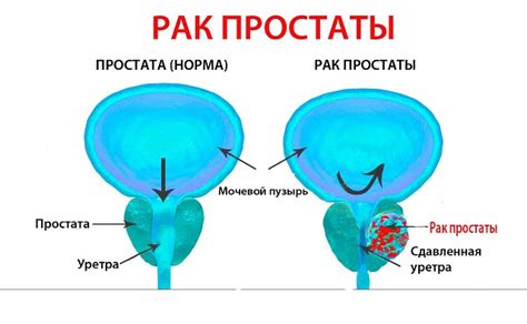 Очаговые образования предстательной железы: значение и причины возникновения