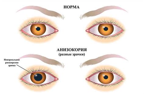 Очные болезни, способствующие неравномерности зрачков