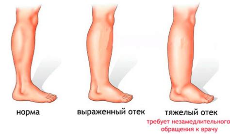 Ощущение тяжести и отеки ног