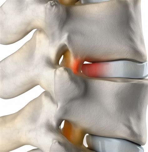 Парамедианная протрузия диска: суть и определение