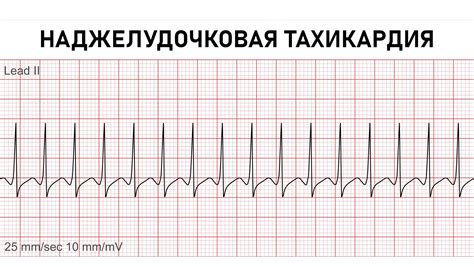 Пароксизмальное тахикардия