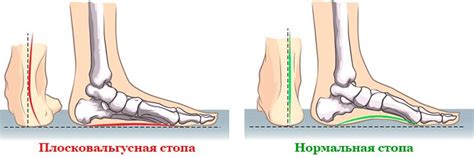 Патологическая плоско-вальгусная стопа